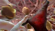 Can Alzheimer's Be Stopped? still